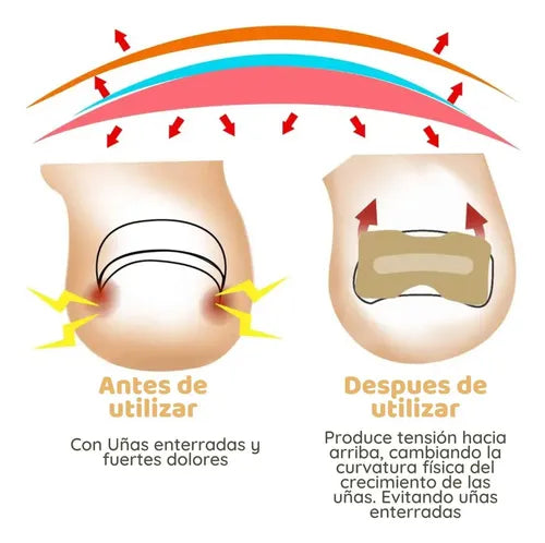 Parche Para Hongos de las Uñas - Págalo Al Recibir en Tu Domicilio